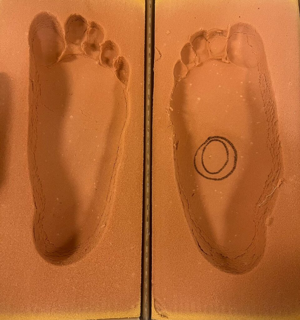 Ingrown Toenails Explained